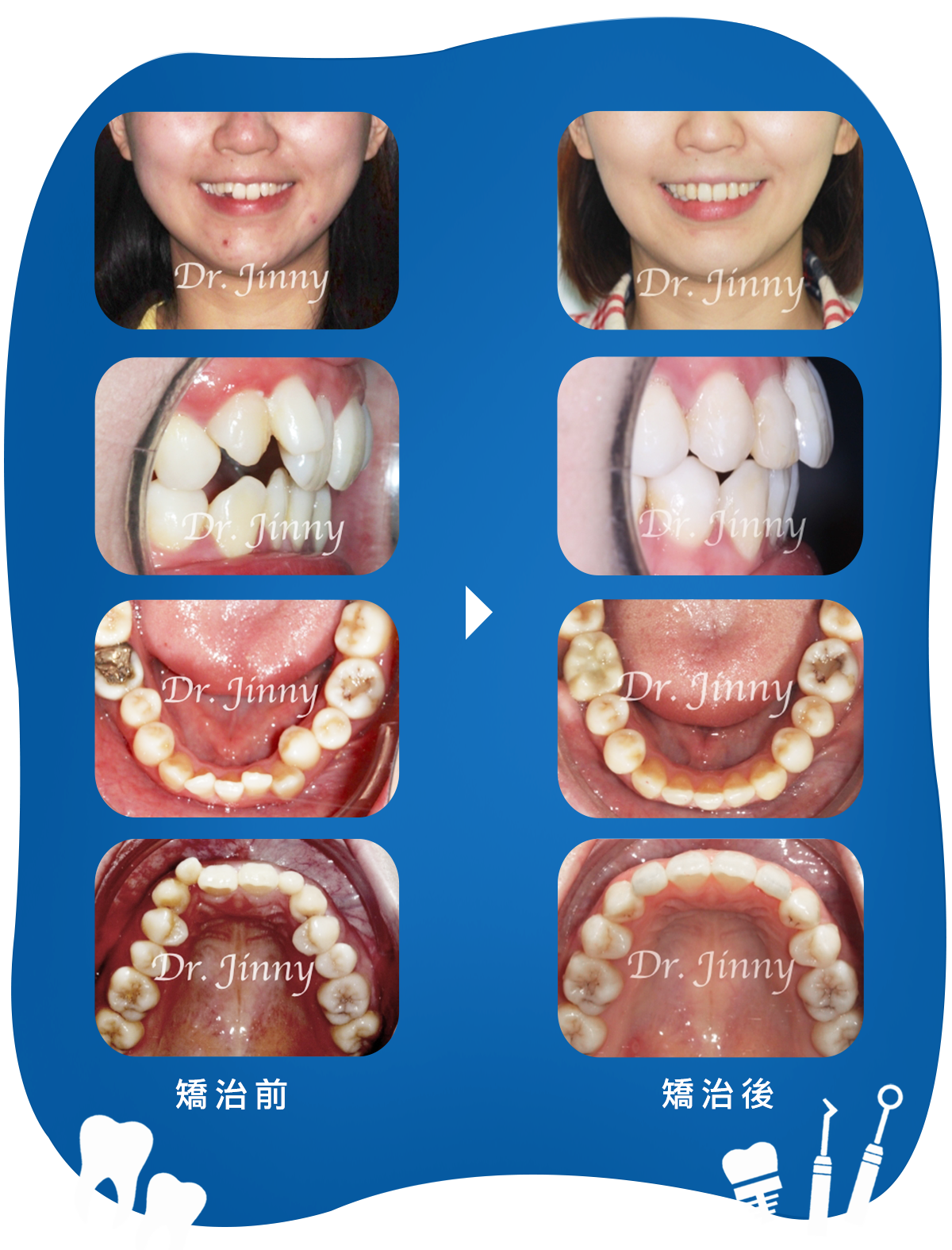 76期，4颗前牙埋伏阻生，反合生成趋势，青少年拔牙矫治一例